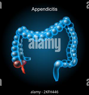 Appendicite. Infiammazione dell'appendice. Intestino crasso su sfondo scuro. Tratto gastrointestinale. Apparato digerente. Anatomia del corpo umano. Vettore Illustrazione Vettoriale