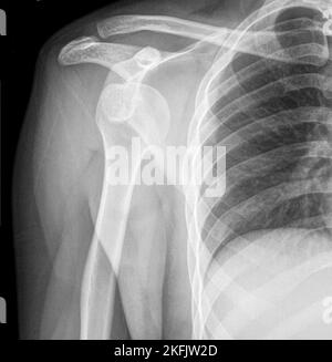 Spalla slogata, X-ray Foto Stock
