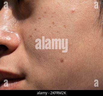 Macchie scure chiamate macchie di età e sul volto dell'uomo asiatico. Sono anche chiamati macchie di fegato, lentigo senile, o macchie di sole. Vista in primo piano. Foto Stock