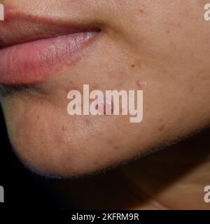 Acne cistica, pimples, macchie nere e cicatrici sulla faccia oleosa della giovane donna asiatica. Foto Stock
