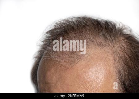 Testa calva dell'anziano asiatico. Concetto di perdita di capelli modello maschio o capelli sparsi. Foto Stock