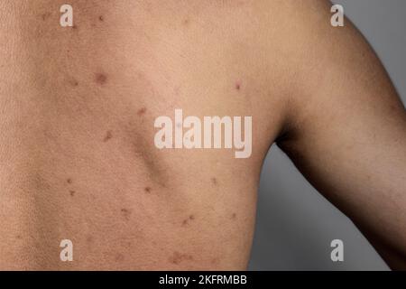 Macchie nere, pimples, acne e cicatrici sulla parte posteriore dell'asiatico, uomo del Myanmar Foto Stock