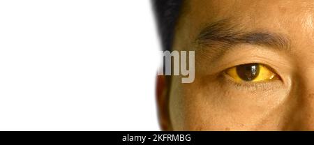 Ittero profondo in pazienti asiatici maschi. Colorazione giallastra della pelle e della sclera. Iperbilirubinemia. Epatite acuta. Foto Stock