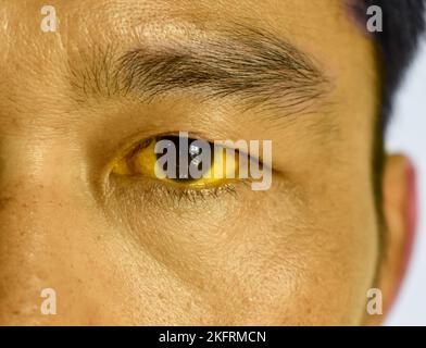 Ittero profondo in pazienti asiatici maschi. Colorazione giallastra della pelle e della sclera. Iperbilirubinemia. Epatite acuta. Foto Stock
