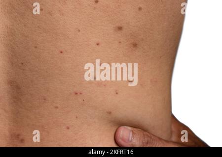 Macchie nere, pimples, acne e cicatrici sulla parte posteriore dell'asiatico, uomo del Myanmar Foto Stock