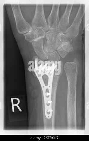 Radiografia di un paziente con frattura distale radiale a destra con avulsione PSU, stabilizzata mediante osteosintesi della piastra con plat angolare stabile Foto Stock