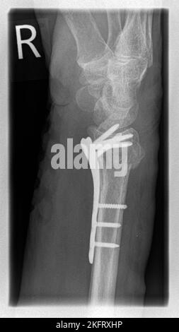 Radiografia di un paziente con frattura distale radiale a destra con avulsione PSU, stabilizzata mediante osteosintesi della piastra con plat angolare stabile Foto Stock