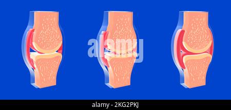 3D illustrazione dell'articolazione sinoviale e di altre articolazioni con osteoartrite e artrite reumatoide. Rappresentazione grafica di ossa, tendini. Foto Stock