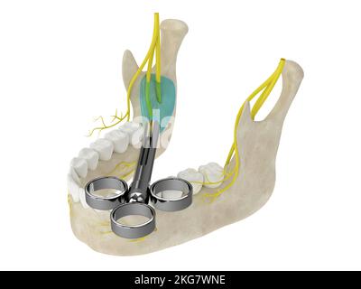 3d rappresentazione dell'arco mandibolare con blocco del nervo alveolare inferiore. Tipi di anestesia dentale concetto. Foto Stock