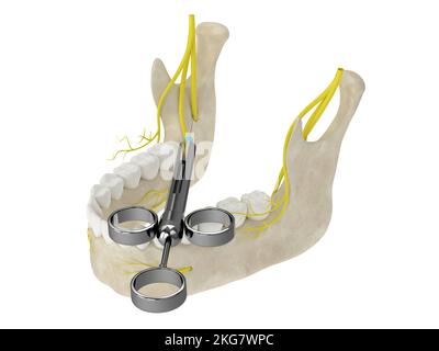 3d rappresentazione dell'arco mandibolare con blocco del nervo alveolare inferiore. Tipi di anestesia dentale concetto. Foto Stock