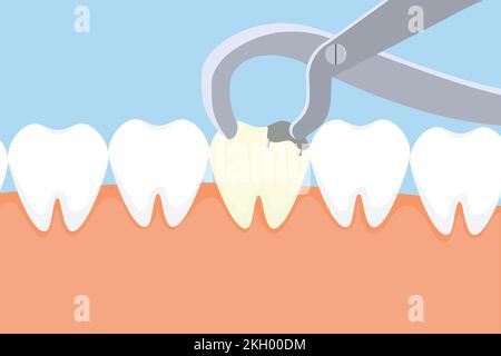 Dentista che tira fuori un dente morto con attrezzatura. Attività di cura dentale con una pinza dentista e un vettore di dente morto. Estrazione denti morti Illustrat Illustrazione Vettoriale