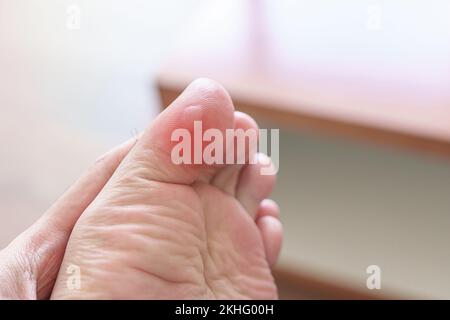 Uomo con dita dei piedi o blister a causa di indossare scarpe strette e svegliarsi o correre lungo, dolore a piedi nudi a causa di fasciite plantare. Salute e medica Foto Stock