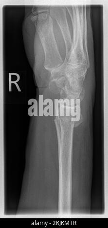 Radiografia di un paziente con frattura distale radiale a destra con avulsione PSU Foto Stock
