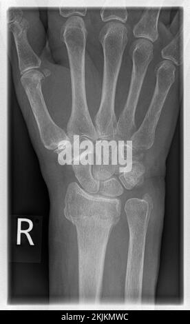 Radiografia di un paziente con frattura distale radiale a destra con avulsione PSU Foto Stock