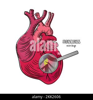 MALATTIE CARDIACHE aterosclerosi malattia cronica Medicina diagramma di educazione Schema vettoriale umano mano disegnata Vector Illustration Illustrazione Vettoriale