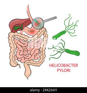 HELICOBACTER PYLORI diagramma di educazione della medicina Schema vettoriale malattia umana Set di illustrazioni vettoriali Illustrazione Vettoriale