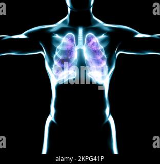 Anatomia umana, problemi al sistema respiratorio, polmoni gravemente danneggiati. Polmonite bilaterale. Covid-19, coronavirus. Paziente e fumo. Fumatore Foto Stock