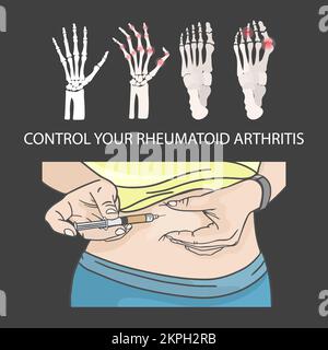 ARTRITE REUMATOIDE CONTROLLO iniezione ipodermica nello stomaco Medical Education Scheme con testo per studenti e scuole clip Art Vector Illustration Illustrazione Vettoriale