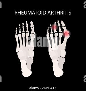 ARTRITE REUMATOIDE GAMBA lesioni focali delle gambe malattia cronica Medicina diagramma di educazione Schema vettoriale Hand Drawn clip Art Vector Illustration se Illustrazione Vettoriale