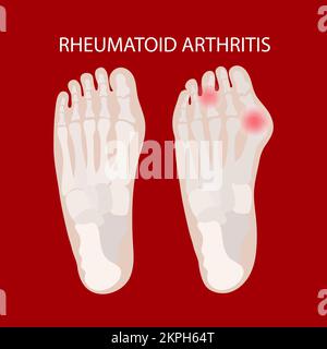 LESIONI DELLE GAMBE REUMATOIDE Artrite Schema educativo per le scuole mediche malattia cronica malattie disegnate a mano clip Art Vector Illustration Set for Print Illustrazione Vettoriale