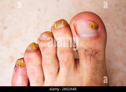 Infezione da funghi sulle unghie del piede maschile Foto Stock