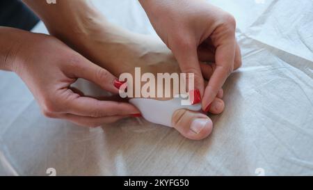 Donna applica stecca di valgo, silicone distanziatore dito primo piano. Foto Stock