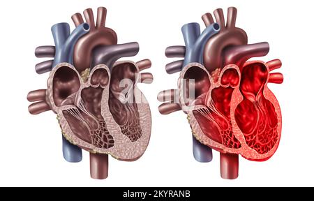 Sindrome del cuore spezzata o cardiomiopatia Takotsubo con un concetto di sezione trasversale di anatomia di un organo cardiovascolare interno Foto Stock