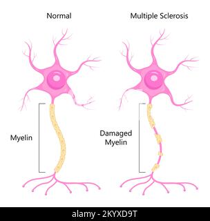 Vettore concettuale Neuron. Dendrite, assone, soma di neurone. Sclerosi multipla, illustrazione dell'anatomia nervosa. Illustrazione Vettoriale