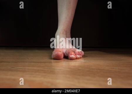Piede di persona con fenomeno di Raynaud e piede piatto, con chillblains e dita gonfie rosse, pelle molto secca, danneggiata piede piatto su sfondo scuro Foto Stock
