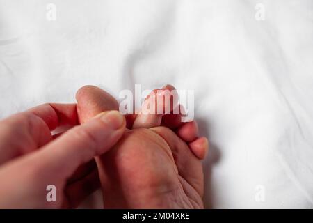 Bambini sulle dita dei piedi, rossore pruriginoso, gonfiore del piede della persona con fenomeno di Raynaud e lesioni dei bambini dermatite pernio sulle dita Perniosi Foto Stock