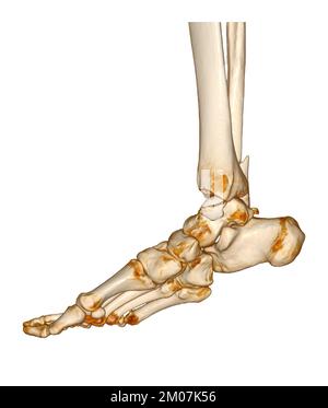 TC eseguire la scansione di caviglia e piede o tomografia computerizzata dell'articolazione della caviglia e del piede immagine 3Drendering che mostra la frattura della tibia e della fibula. Foto Stock