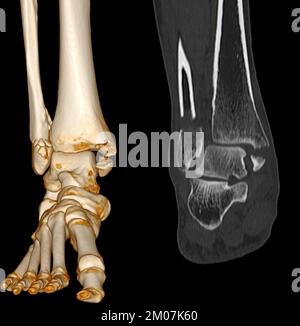 TC eseguire la scansione di caviglia e piede o tomografia computerizzata dell'articolazione della caviglia e del piede immagine 3Drendering che mostra la frattura della tibia e della fibula. Foto Stock