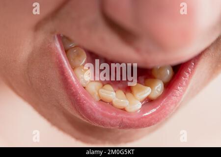 Maschio europeo a bocca aperta crooked denti gialli labbra secche Foto Stock