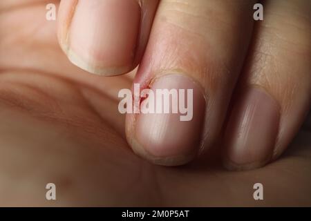 dito danneggiato con infiammazione della ferita primo piano. malattie delle unghie e della pelle. Trattamento della piastra unghie. Cura della salute delle unghie. Foto Stock