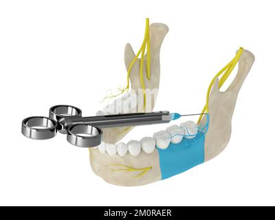 Arco mandibolare con blocco nervoso buccale. Tipi di anestesia dentale concetto. Foto Stock