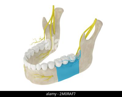 Arco mandibolare con blocco nervoso buccale. Tipi di anestesia dentale concetto. Foto Stock