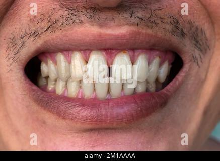 Enorme divario tra i denti anteriori o gli incisivi dell'uomo cinese asiatico. Diastema. Foto Stock