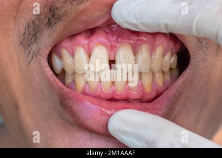 Enorme divario tra i denti anteriori o gli incisivi dell'uomo cinese asiatico. Diastema. Foto Stock