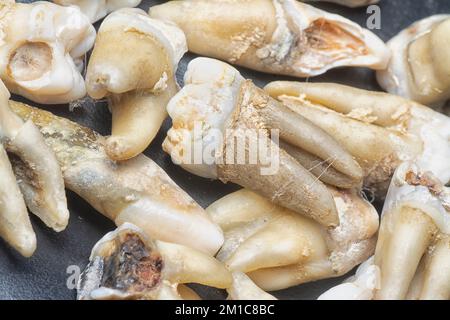 il fascio di denti umani di decadimento estratti indesiderati. Foto Stock