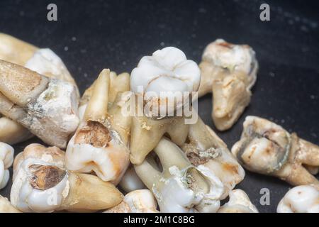 il fascio di denti umani di decadimento estratti indesiderati. Foto Stock