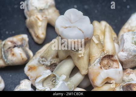 il fascio di denti umani di decadimento estratti indesiderati. Foto Stock