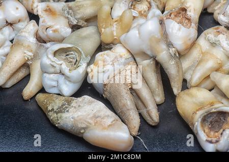il fascio di denti umani di decadimento estratti indesiderati. Foto Stock