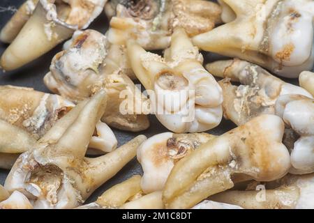 il fascio di denti umani di decadimento estratti indesiderati. Foto Stock
