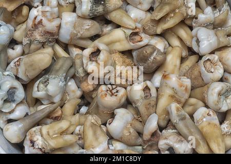 il fascio di denti umani di decadimento estratti indesiderati. Foto Stock