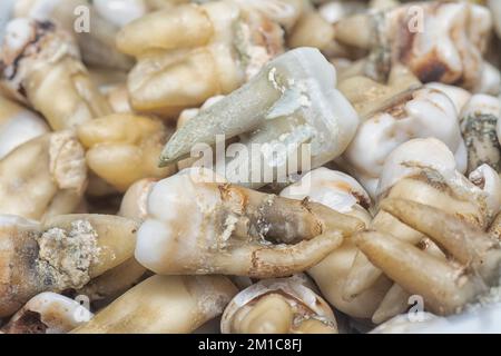 il fascio di denti umani di decadimento estratti indesiderati. Foto Stock