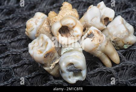 il fascio di denti umani di decadimento estratti indesiderati. Foto Stock