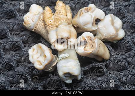il fascio di denti umani di decadimento estratti indesiderati. Foto Stock