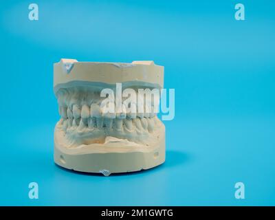 Getti dentali su sfondo blu. Modello di denti in gesso. Primo piano. Foto Stock
