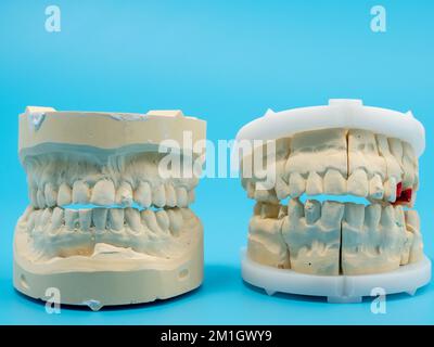 Getti dentali su sfondo blu. Modello di denti in gesso. Primo piano. Foto Stock