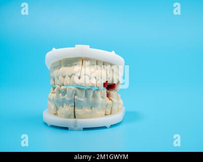Getti dentali su sfondo blu. Modello di denti in gesso. Primo piano. Foto Stock